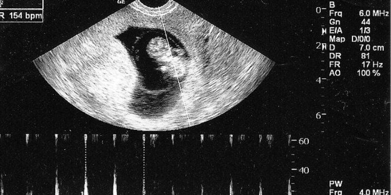 Siêu Âm Tim Thai 6 Tuần