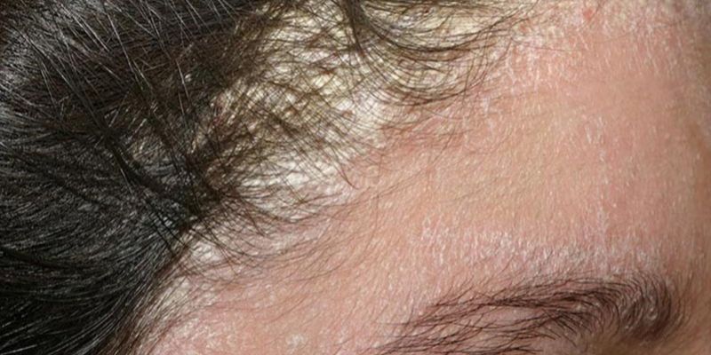 Cách Điều Trị Bệnh Nấm Da Đầu Ở Người Lớn