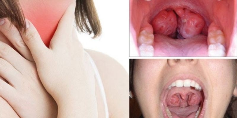 Phòng ngừa tình trạng đờm ở cổ họng lâu ngày