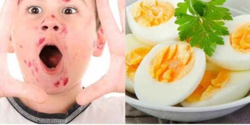 Bị thủy đậu có được ăn trứng không