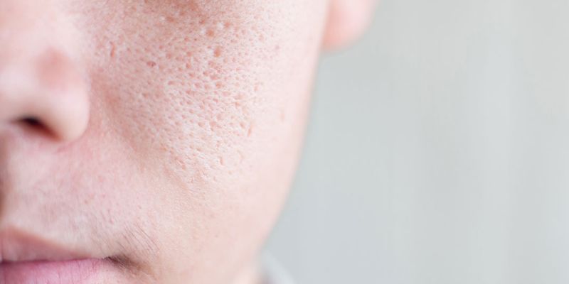 Nguyên Nhân Khiến Lỗ Chân Lông To