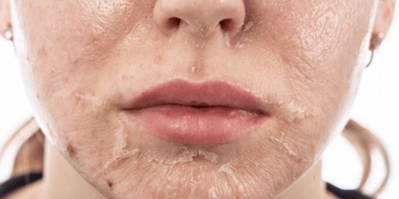 Những Điều Cần Tránh Sau Peel Da