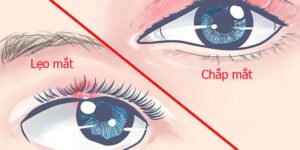 Chắp và lẹo mắt: nguyên nhân triệu chứng và cách điều trị