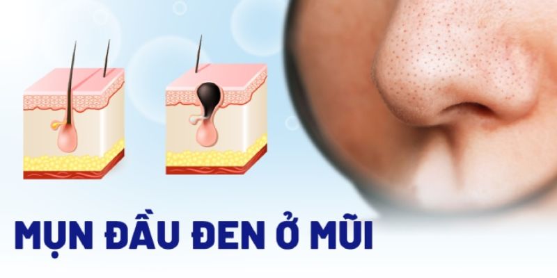 Nguyên nhân gây mụn đầu đen ở mũi hình thành là gì?