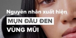 Nguyên Nhân Gây Mụn Đầu Đen Ở Mũi – Hiểu Rõ Để Ngăn Ngừa Hiệu Quả