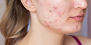 Sẹo Thâm Bao Lâu Sẽ Hết – Quá Trình Phục Hồi Da Và Cách Đẩy Nhanh Hiệu Quả