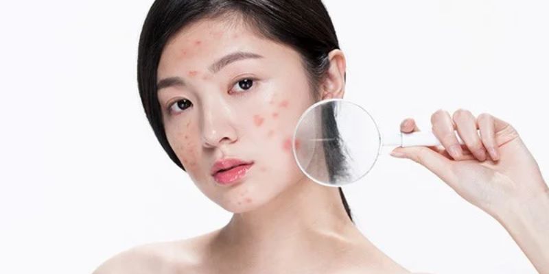 Hạn Chế Trang Điểm Khi Da Đang Bị Mụn