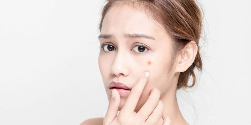 Nguyên Nhân Gây Mụn